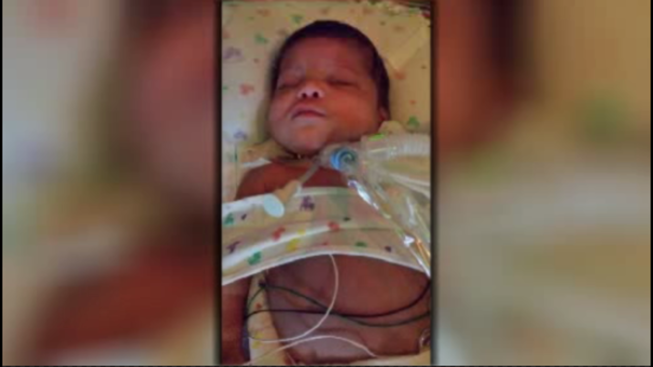 Doctors develop tracheostomy removal procedure for young kids